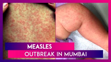 Measles Outbreak In Mumbai: Toddler Dies In The City; 126 Children Infected With The Airborne Viral Infection