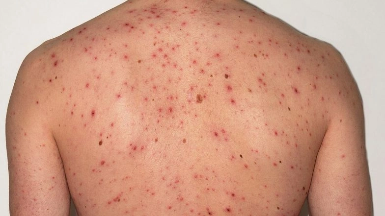 Measles Outbreak in Mumbai: 10 Fresh Cases Recorded, No Fatalities, Says BMC Report