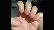 Hand Without Fingernails: Viral Image of This Rare Medical Condition Has Left The Internet Dumbstruck