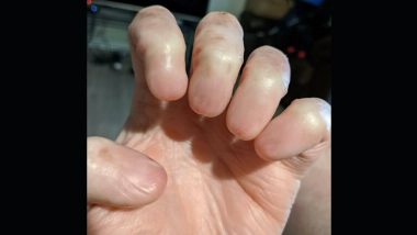 Hand Without Fingernails: Viral Image of This Rare Medical Condition Has Left The Internet Dumbstruck