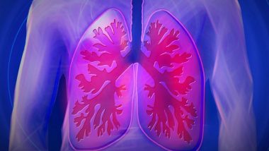 Imaging Agent Helps to Remove Lung Cancer Tumors: Study