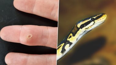 Snake Tooth Gets Lodged In Man's Swollen Finger; He Finds It Out After Years of 'Unmerciful Pain' (See Pics)