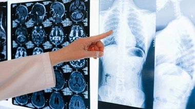 Health News | Hospitalization During COVID-19 Damages Lungs: Study