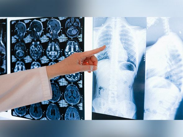 Health News | Hospitalization During COVID-19 Damages Lungs: Study - Vimarsana News