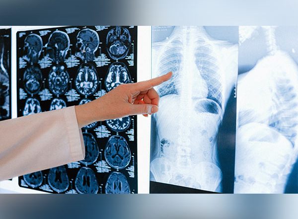 Health News | Hospitalization During COVID-19 Damages Lungs: Study