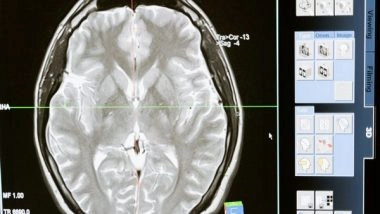 Health News | Study Explains Why Women Are at Greater Risk to Suffer from Alzheimer's