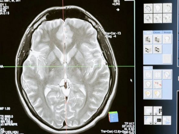 Health News | Traumatic Brain Injury, PTSD Associated with Alzheimer's: Research - Vimarsana News