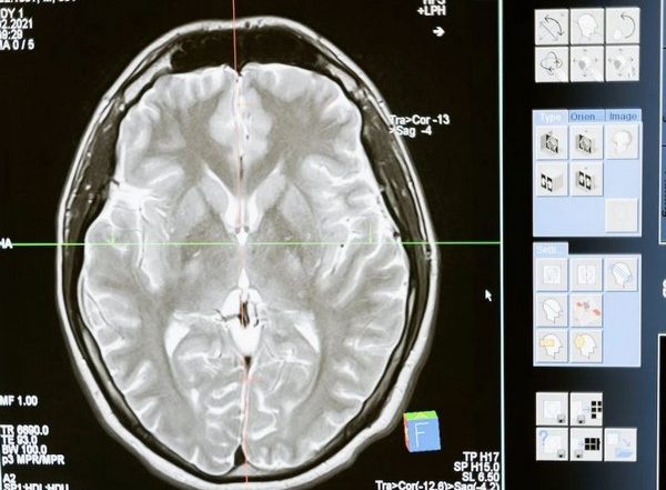 Health News | Traumatic Brain Injury, PTSD Associated with Alzheimer's: Research