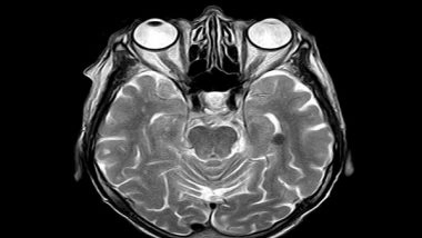 Science News | Brain Area Required for Fluid Intelligence Identified