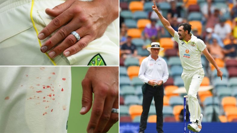 Blood on Trouser! Mitchell Starc Bowls Through Pain During AUS vs SA 2nd Test at Melbourne After Dislocating Tip of Finger On Day 1