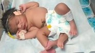 Madhya Pradesh: Woman Gives Birth to Baby Girl With &lsquo;Four&rsquo; Legs at Kamla Raja Hospital&nbsp;in Gwalior