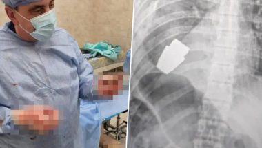 Live Bomb Inside Body! Surgeon Performs Operation to Remove The Unexploded Grenade From Torse of Ukrainian Soldier; See Pic 