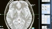 Health News | Study Reveals Link Between Metabolism Changes, Huntington's Disease