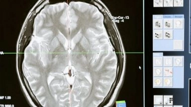 Health News | Study Reveals Link Between Metabolism Changes, Huntington's Disease