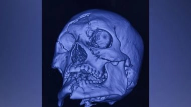 India News | Delhi Doctors Save Life, Restore Face of Motorcyclist Crushed in Road Accident