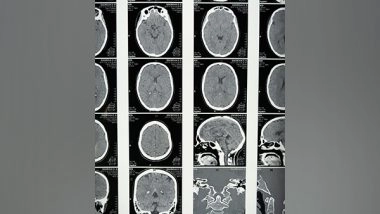 Science News | Researchers Use MRI Data to Predict Brain Tumor Progression