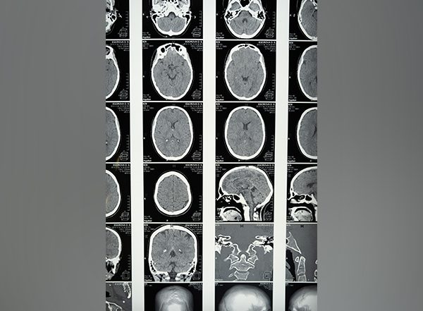 Science News | Researchers Use MRI Data to Predict Brain Tumor Progression