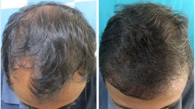 Business News | VCare's Hair Transplantation Ensures To Completely Reverse Baldness