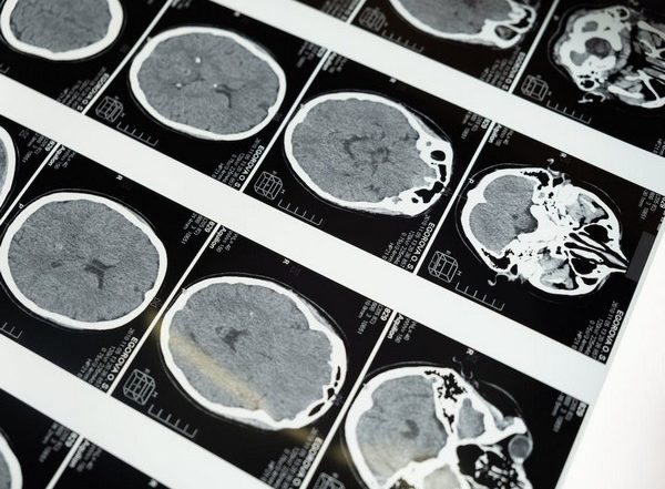 Health News | Study Reveals How Huntington's Disease Affects Different Neurons