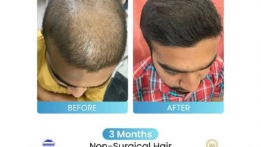 Business News | Dr Stuti Khare Shukla's Non-Surgical Hair Growth Booster Helping Multiple People Suffering from Hair Loss Issues