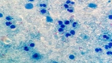 Health News | Marburg Vaccine Shows Promising Results in First-in-human Study