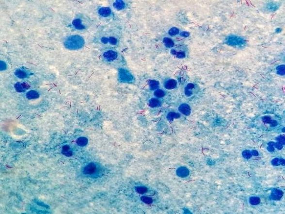 Health News | Marburg Vaccine Shows Promising Results in First-in-human Study - Vimarsana News