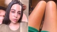Uorfi Javed Reveals She's 'Allergic' to Clothes on Insta, Shares Video of Boils All Over Her Legs &ndash; WATCH