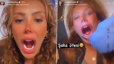 Turkish Influencer Undergoes Emergency Surgery After Her Date Bites Through Her Tongue During Their First Kiss; Watch Viral Video 