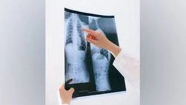 Health News | AI Can Improve Lung Nodule Detection in Chest X-rays: Study