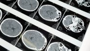 Health News | Study: Autism-related Behavioural Disorders Associated to Genetic Changes