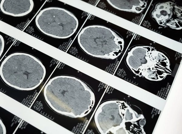 Health News | Study: Autism-related Behavioural Disorders Associated to Genetic Changes