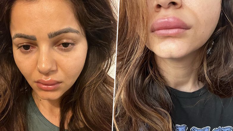 Rubina Dilaik Down With Fever; Actress Shares Pics of Her Swollen Lips on Insta (View Post)