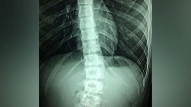 Health News | Spinal Cord Stimulation Help People with Diabetic Neuropathy