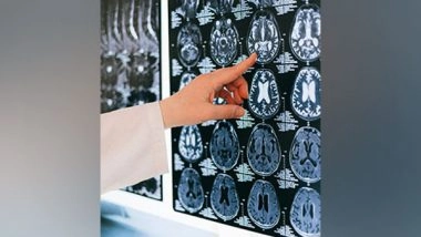 Science News | Research: Alzheimer's Development Linked to Cholesterol, Toxic Protein Clusters