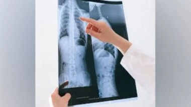 Health News | Study Reveals How Nerves, Immune Cells Interaction in Lungs Can Contribute in Development of  Allergic Asthma