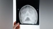 Health News | Study: Risk of Skull Fractures is Higher in Men Than Women