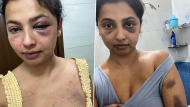 Anicka Vijayi Vikramman Claims She Was Mentally and Physically Tortured by Her Ex; Actress Shares Pics of Her Bruised Body and Face (View Post)