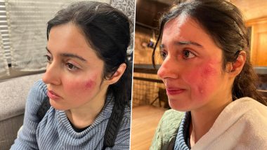 Divya Khosla Kumar Reveals She Got 'Badly Injured' While Shooting an Action Sequence, Shares Pics of Her Bruised Face