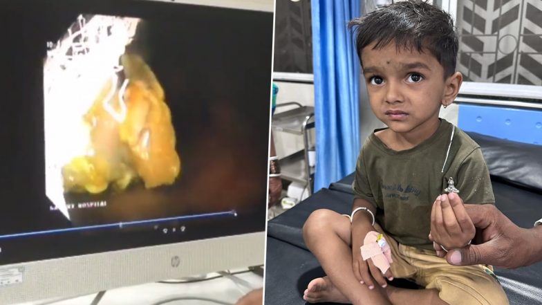 Maharashtra: Doctors Remove Lord Hanuman Locket From Child’s Throat He Swallowed Playing in Nanded (Watch Video)