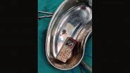 Madhya Pradesh: 15-Year-Old Girl Swallows Mobile, Doctors Take Out From Her Stomach Successfully After Operation in Gwalior