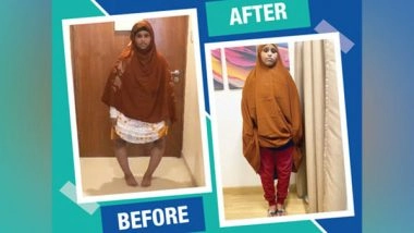 Business News | From Deformity to Mobility: 16-year-old Girl's Life Transformed with Corrective Surgery by Doctors at Manipal Hospitals, Delhi