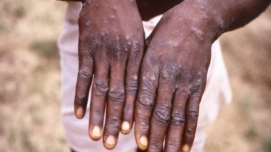 Monkeypox in Pakistan: Country Reports First Case of Mpox