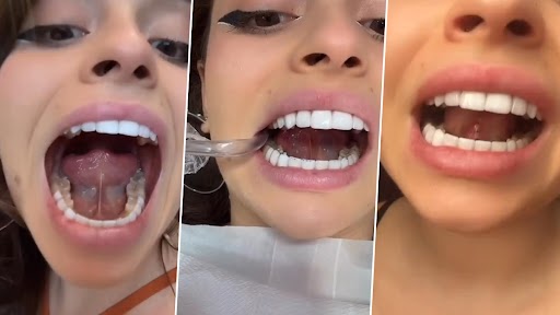 Instagram Influencer Xehli G Gets Part of Her Tongue Cut Off to Become a 'Better Kisser', Shares Video