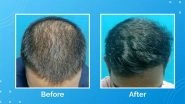 Business News | VCare's Treatment for Hair Loss and Hair Thinning