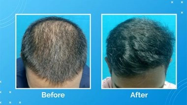 Business News | VCare's Treatment for Hair Loss and Hair Thinning