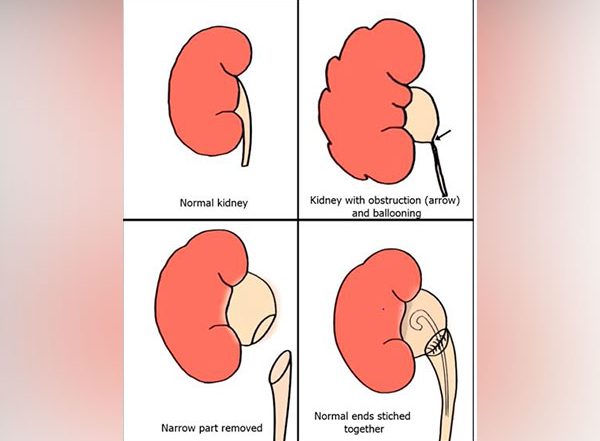 Delhi AIIMS Sets World Record, Performs Groundbreaking Surgery on Three-Month-Old Baby to Remove Obstructions in Kidneys