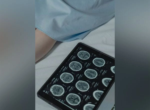 Science News | Monitoring Blood Vessel Changes Improves Detection of Brain Diseases: Study