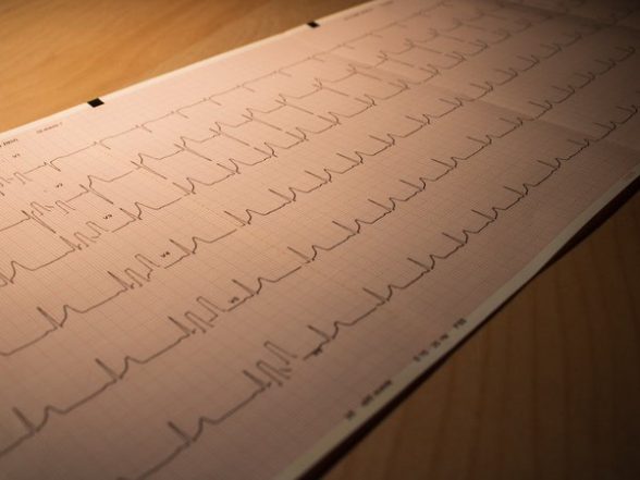 Health News | Strong Legs Improve Prognosis for Heart Attack Patients: Study - Vimarsana News
