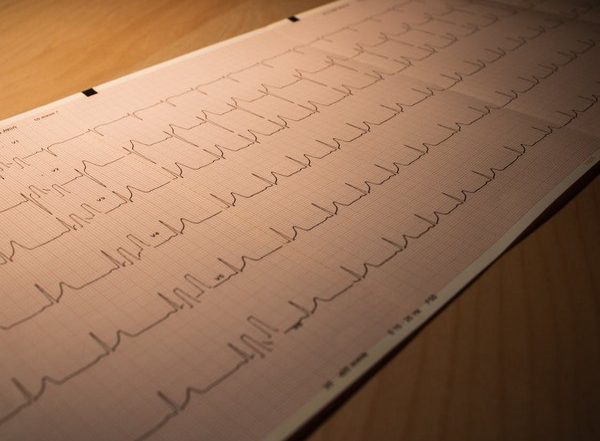 Health News | Strong Legs Improve Prognosis for Heart Attack Patients: Study