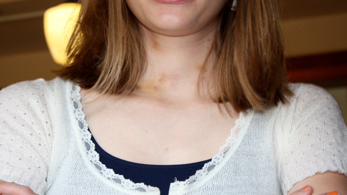 Hickeys on Body From Cold Compress to Makeup, 5 Easy Ways To Hide a Hickey or Love Bite 🛍️ LatestLY picture image